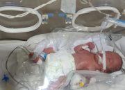 Bayi Lahir Prematur Komplikasi Gangguan Pernapasan